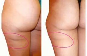 MyBodyContour
