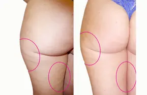MyBodyContour