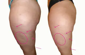 MyBodyContour